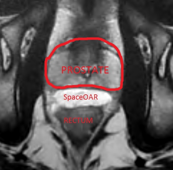 SpaceOAR MRI